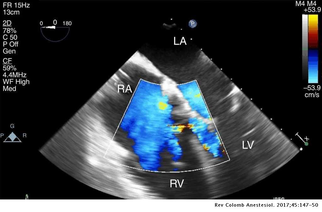 Intraoperative transesophageal echocardiography to evaluate a Gerbode ...