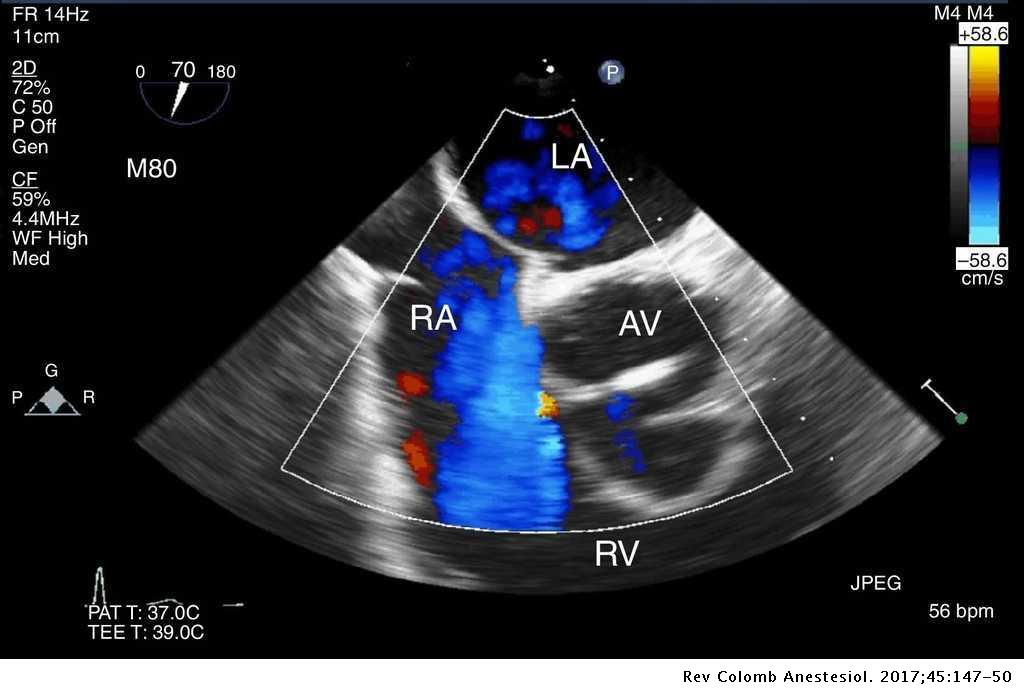 Intraoperative transesophageal echocardiography to evaluate a Gerbode ...