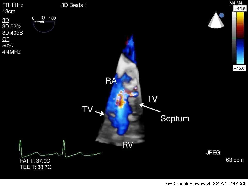 Intraoperative transesophageal echocardiography to evaluate a Gerbode ...