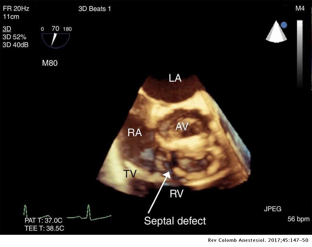Intraoperative transesophageal echocardiography to evaluate a Gerbode ...