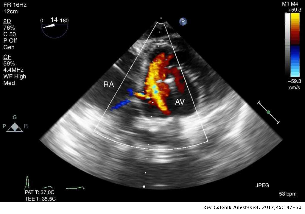 Intraoperative transesophageal echocardiography to evaluate a Gerbode ...