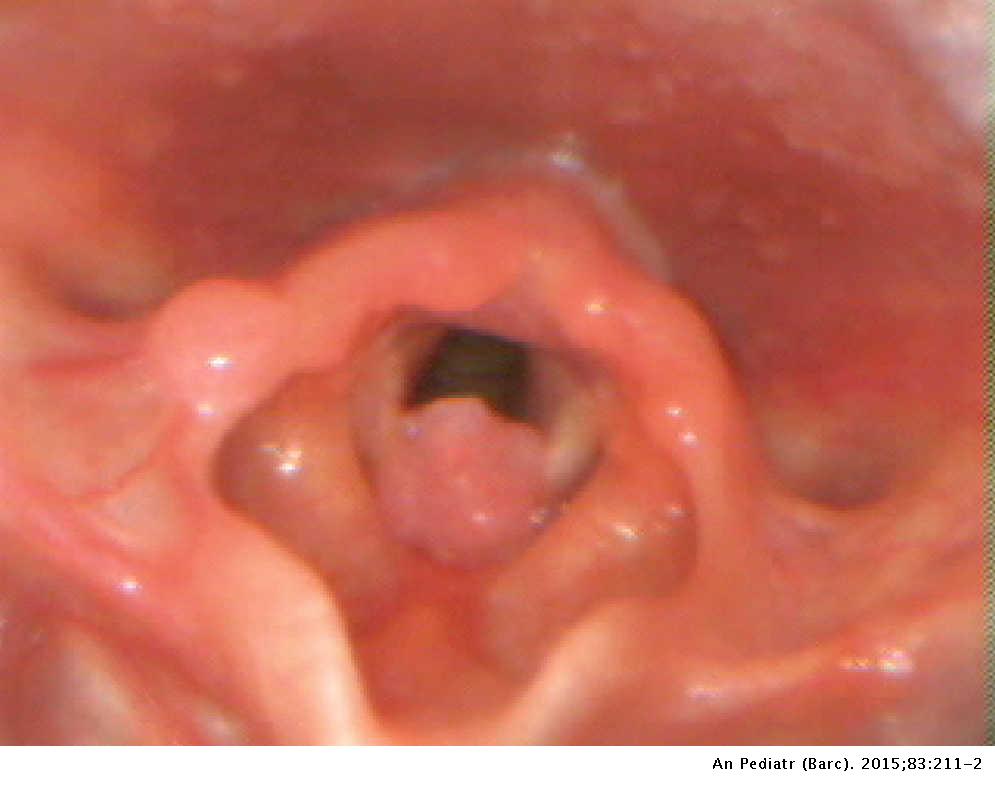 pharyngeal papillomas