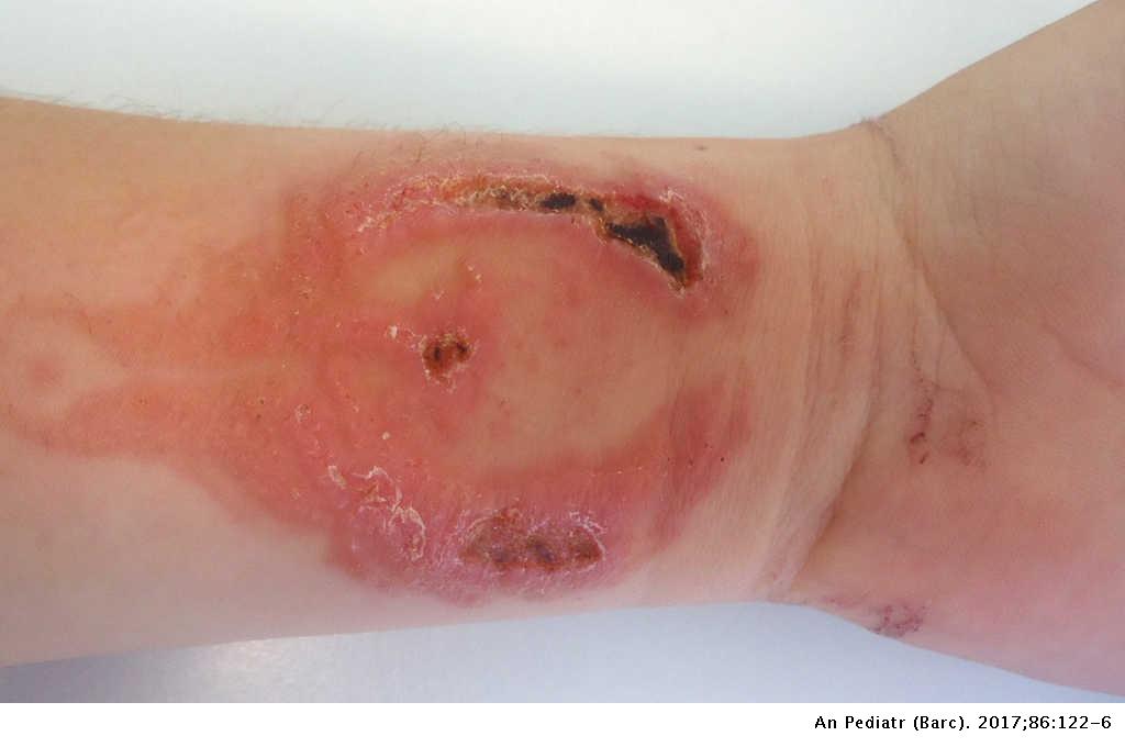 Para-phenylenediamine allergic contact dermatitis due to henna tattoos in a  child and adolescent population | Anales de Pediatría