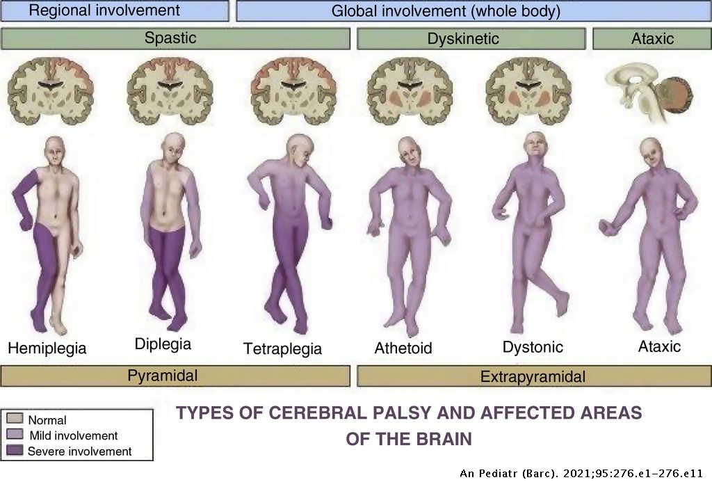 What is cerebral palsy