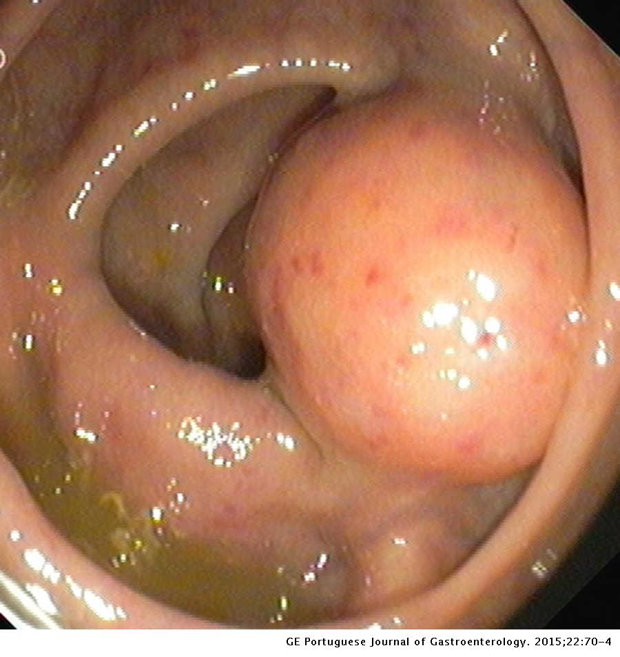 A. Colonoscopic view of the rectal subepithelial lesion 