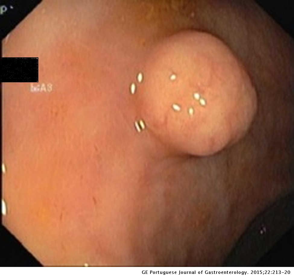 Most small bowel cancers are revealed by a complication
