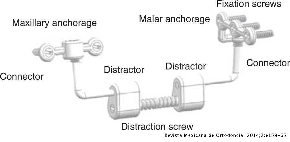 Design of an internal distraction device for maxillary advancement in ...