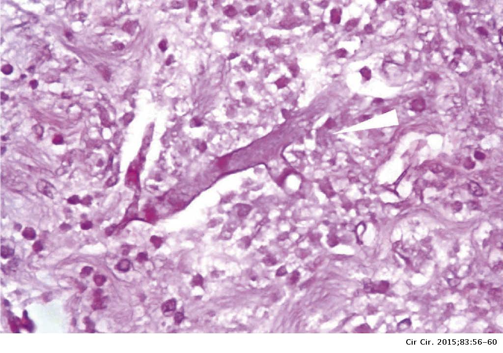 Mucormycosis Mucormycosis