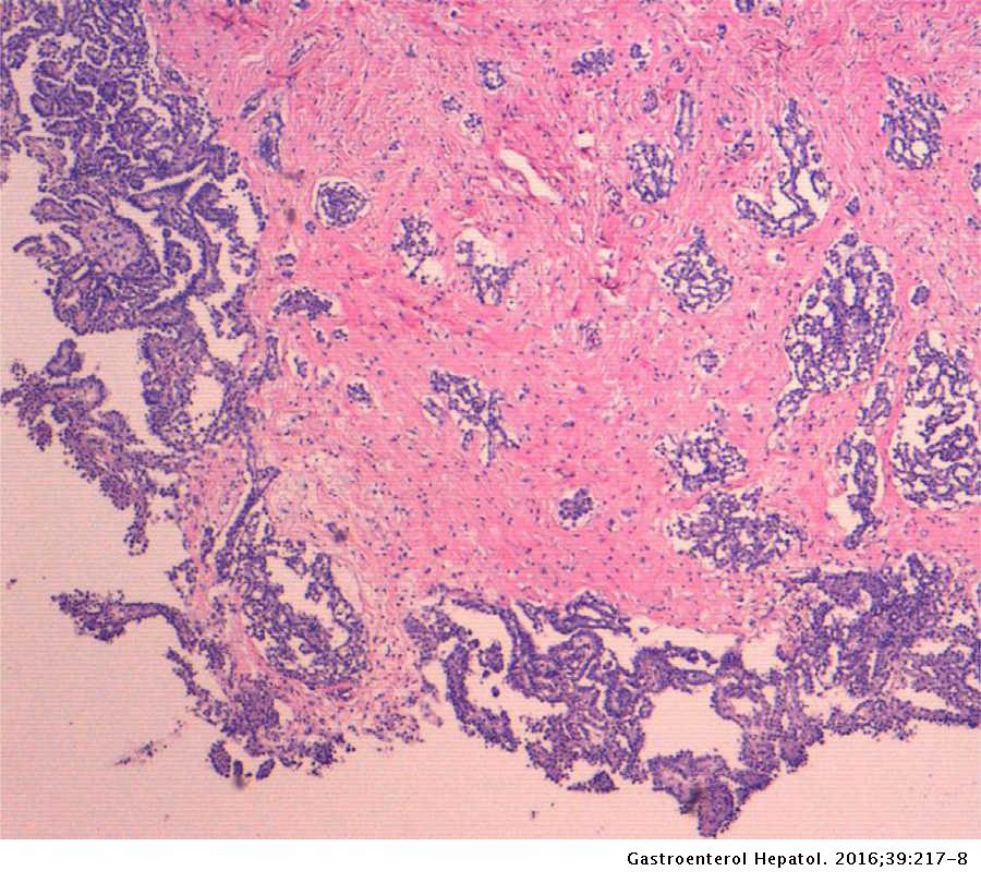 Peritoneal mesothelioma unmasked by an acute appendicitis ...