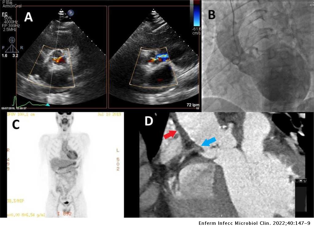 The forgotten and silent enemy of the cardiovascular system: A rare ...