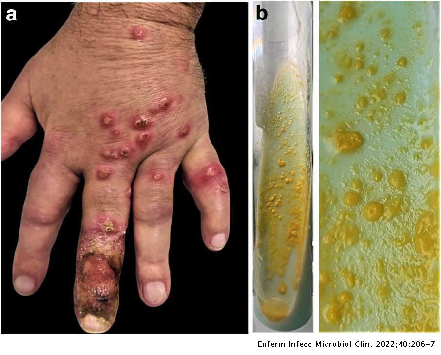 Cutaneous papules in a sporotrichoid pattern on the hand Enfermedades