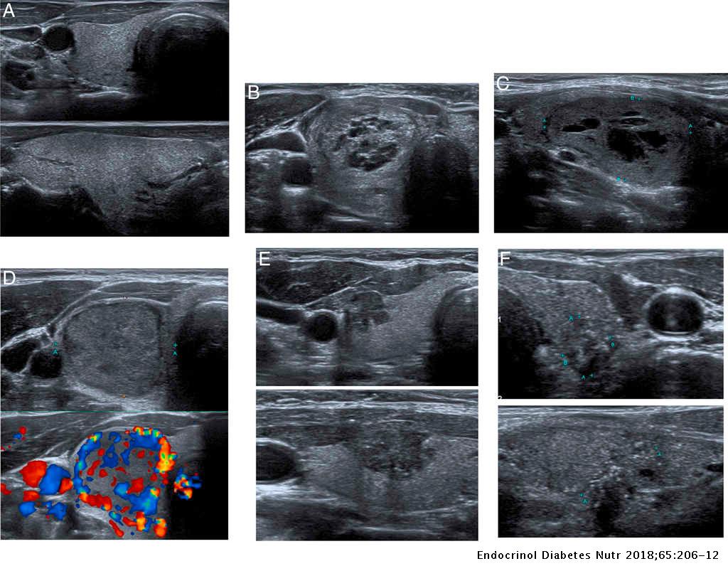 A correlation study between histological results and thyroid ultrasound ...