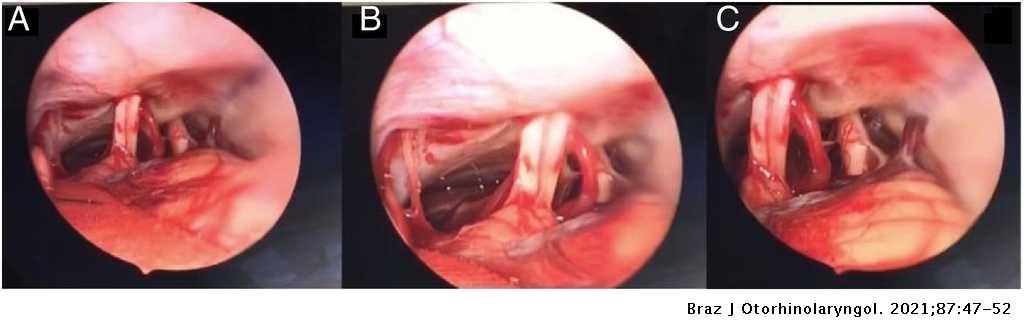 Abordagem retrosigmoide minimamente invasiva assistida por endoscopia para  remoção de cistos aracnóides no conduto auditivo interno: descrição passo a  passo | Brazilian Journal of Otorhinolaryngology