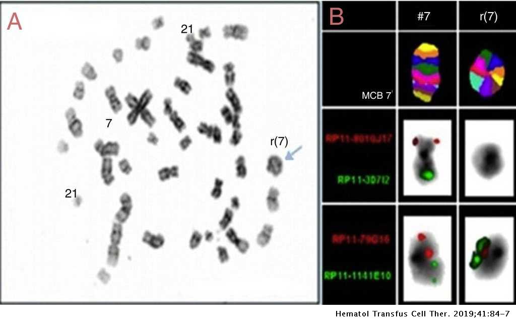 bruiloft Autorisatie Woordvoerder Minimally differentiated acute myeloid leukemia with ring/marker derived  from chromosome 7 in a child with Down syndrome | Hematology, Transfusion  and Cell Therapy