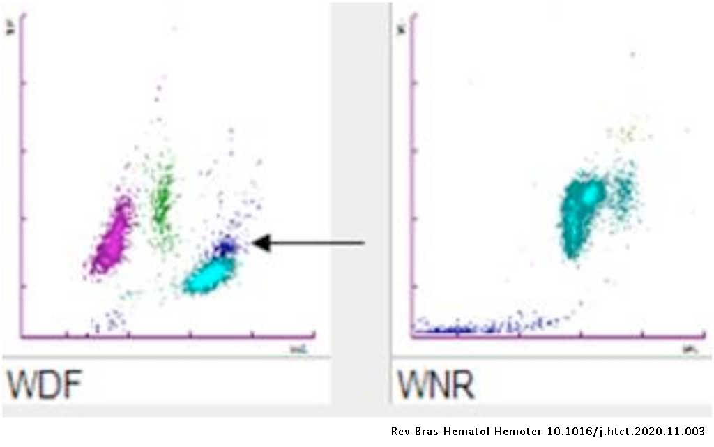 Unusual leukoagglutination: A rare haematological finding | Hematology ...