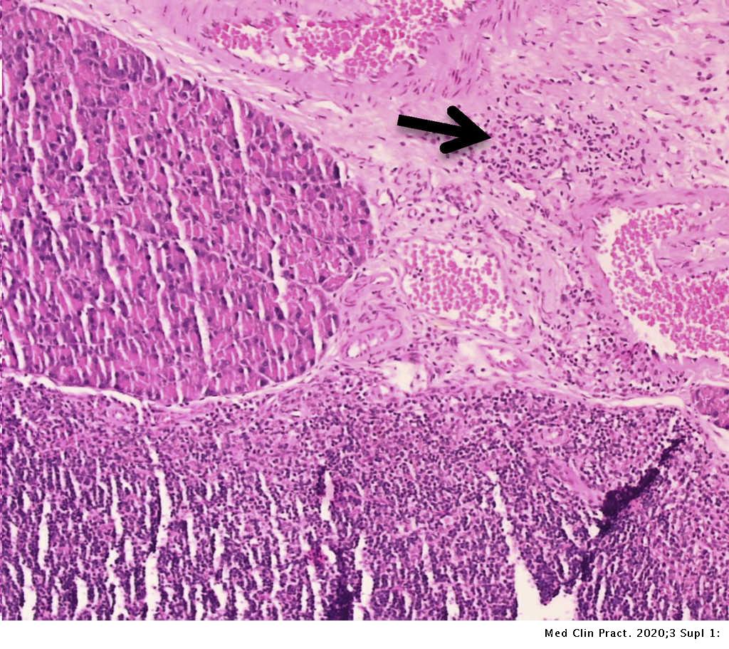 Breadfruit Leaves Extract Artocarpus Altilis Effect On Pancreatic Damage In Diabetic Type Ii Animal Model Induced By Alloxan Nicotinamide Medicina Clinica Practica