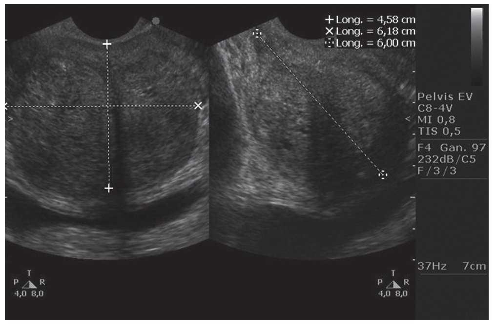 ecografia transrectal prostata