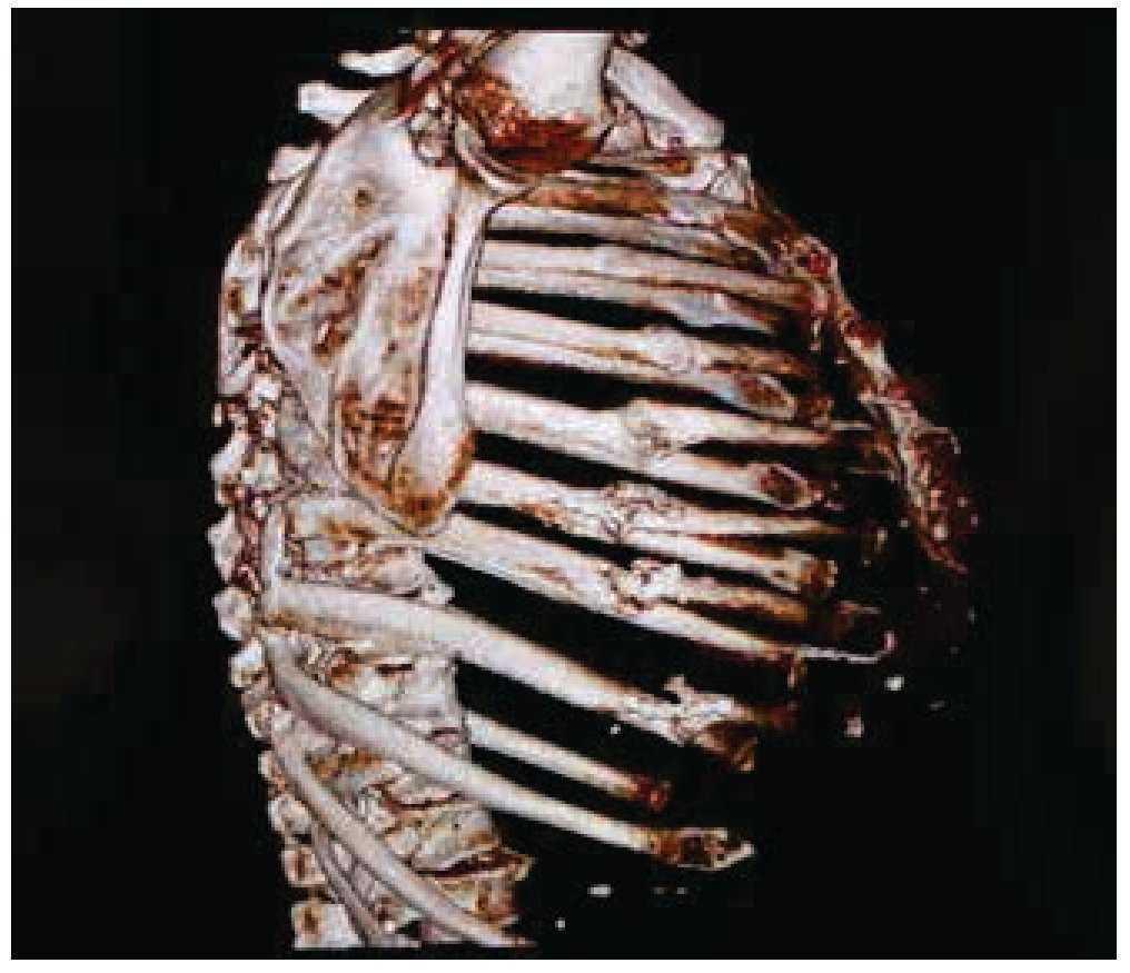 compromiso biomecanica de torax