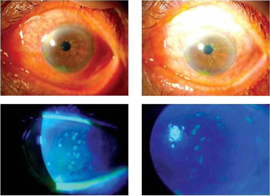 Queratitis En Archipielago Asociada A Herpes Zoster Oftalmico Reporte De Un Caso Revista Mexicana De Oftalmologia