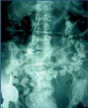 Hiperamilasemia y broncoaspiración asociadas a Carbonato de Lantano