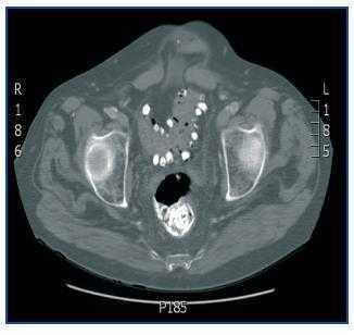 Imagen Radiologica Del Carbonato De Lantano Nefrologia