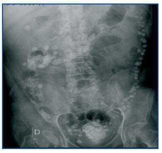 Imagen Radiologica Del Carbonato De Lantano Nefrologia