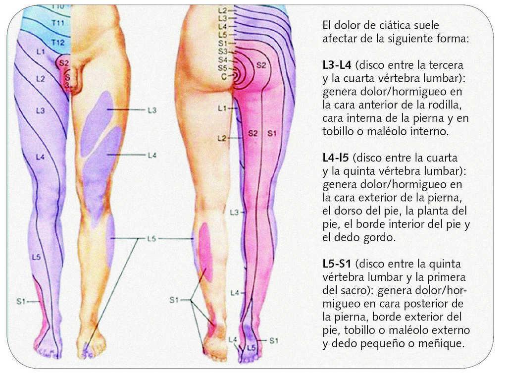 Hernia lateral síntomas