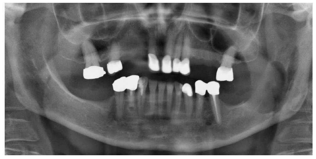 Radiografia de maxilar y mandibula