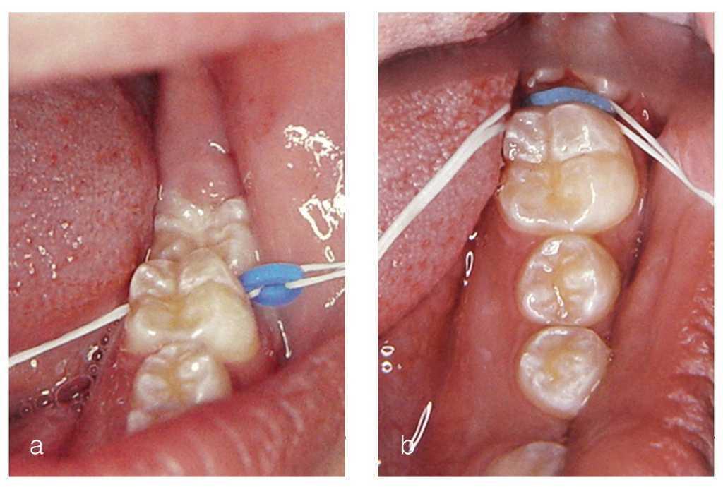 Suavemente adoptar el estudio Enderezamiento de segundos molares inferiores impactados mediante anillos elásticos separadores de ortodoncia | Quintessence Suavemente adoptar el estudio Enderezamiento de segundos molares inferiores impactados mediante anillos elásticos separadores de ortodoncia | Quintessence