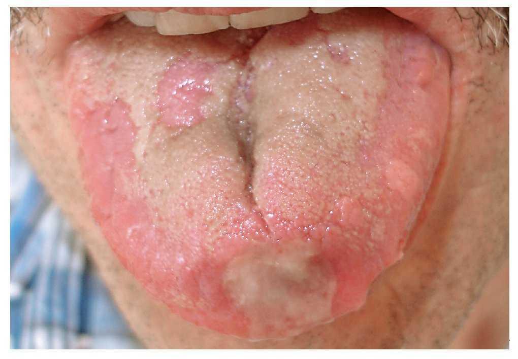 cancer bucal derivado de infecciones virales