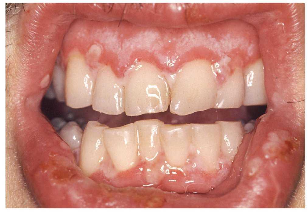 cancer bucal derivado de infecciones virales