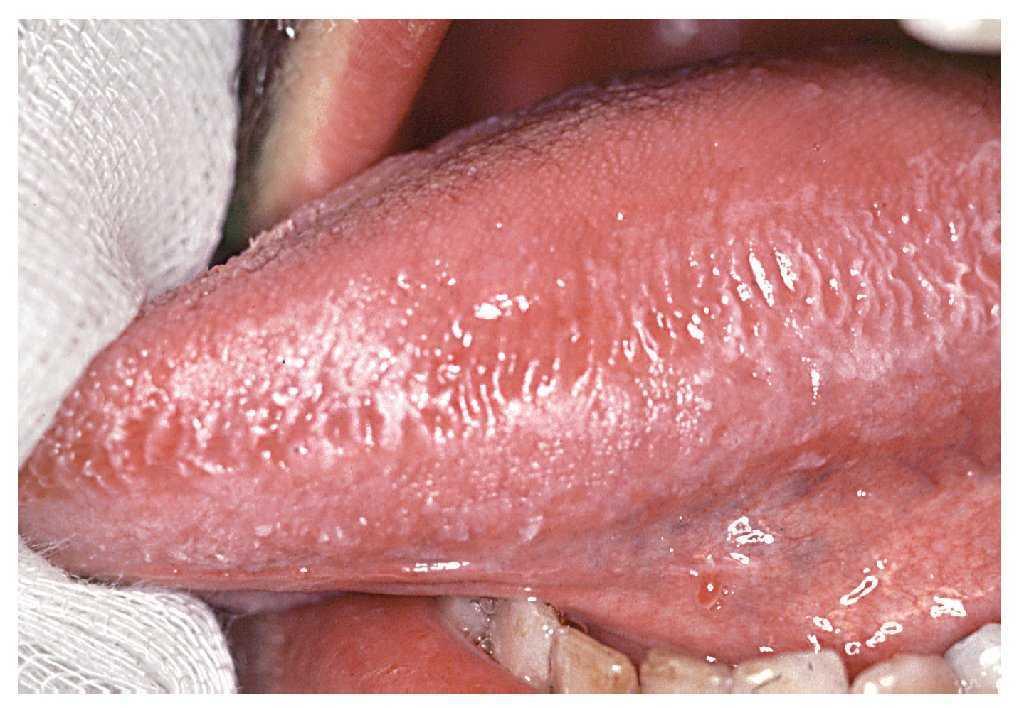 infecciones en la boca por papiloma)