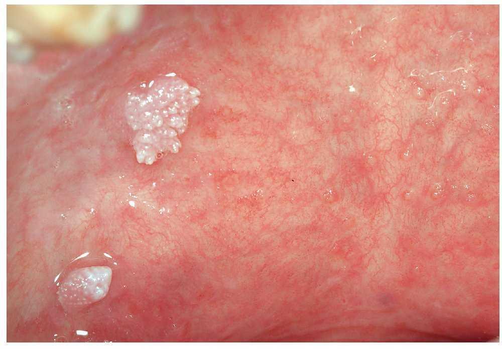 travesura enlace patrón Enfermedades víricas y bacterianas de la mucosa oral | Quintessence