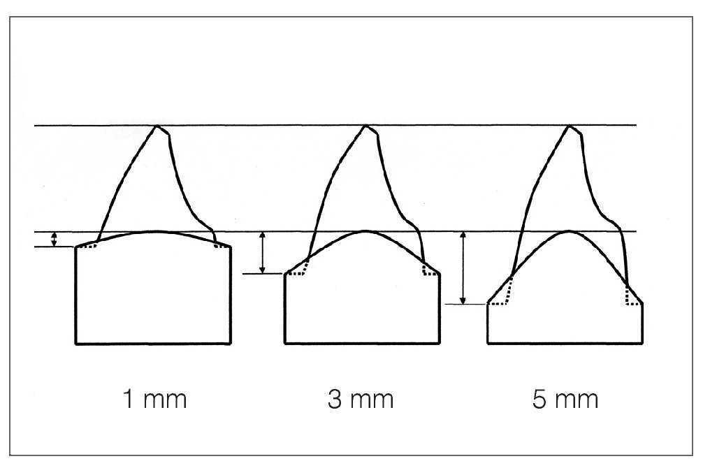 Efecto de la curvatura de la línea de acabado sobre el ajuste marginal ...