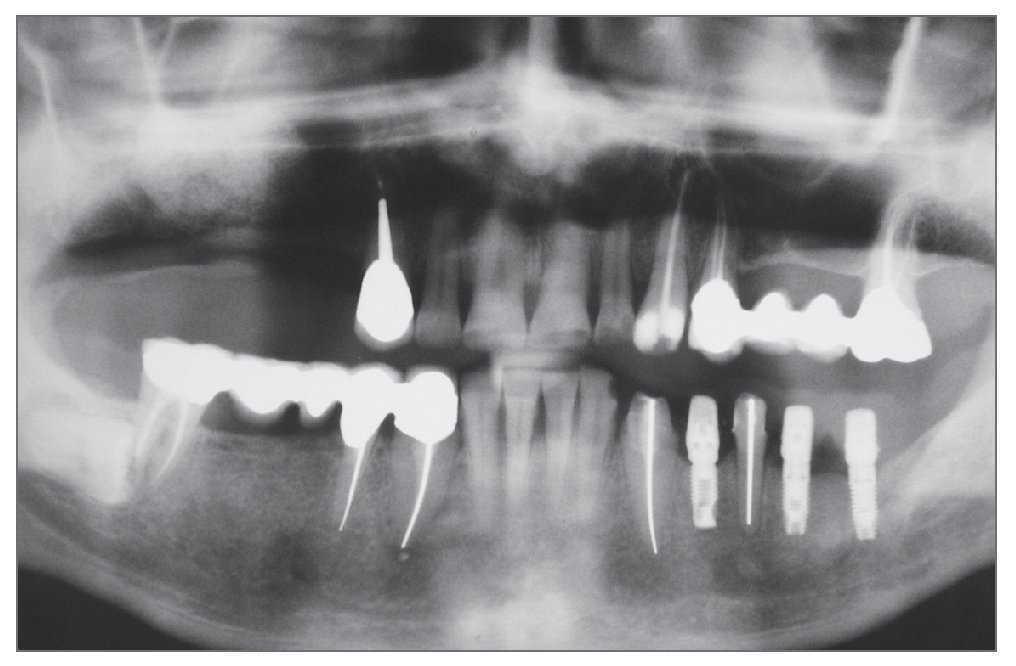 Division De La Cresta Y Colocacion Inmediata De Implantes Mediante Cirugia Osea Ultrasonica Piezocirugia Seguimiento A Tres Anos De 180 Zonas Tratadas Con Implantes Quintessence