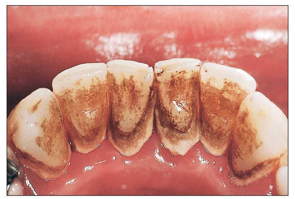 Periodontitis