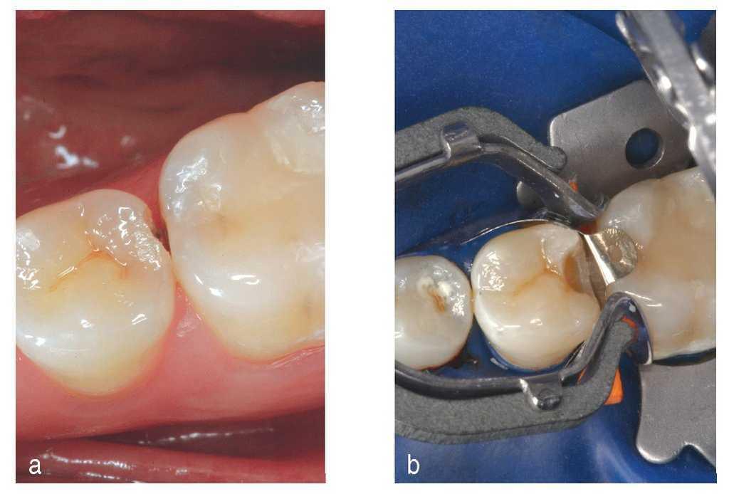 Cuando Es Necesario Un Tratamiento Invasivo De La Caries Y Cuando Es Suficiente Con La Profilaxis Criterios Para Facilitar La Toma De Decisiones En La Practica Odontologica Diaria Quintessence