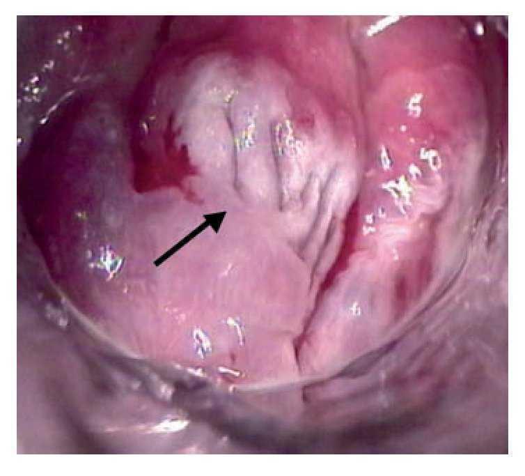 Papiloma escamoso perianal - Endoscopia de Papiloma Grande del Esofago tratament de helmint la chow