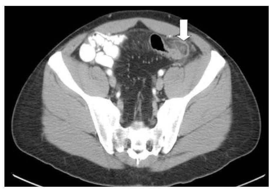 appendix epiploica ct