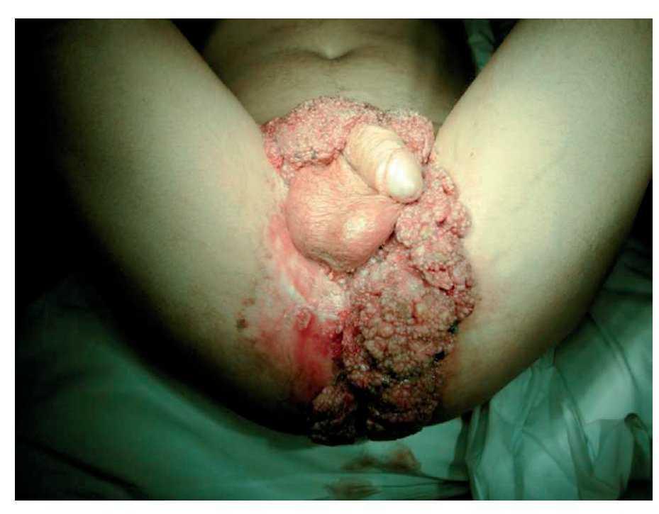 ovarian cancer with ascites paraziti u krvi covjeka