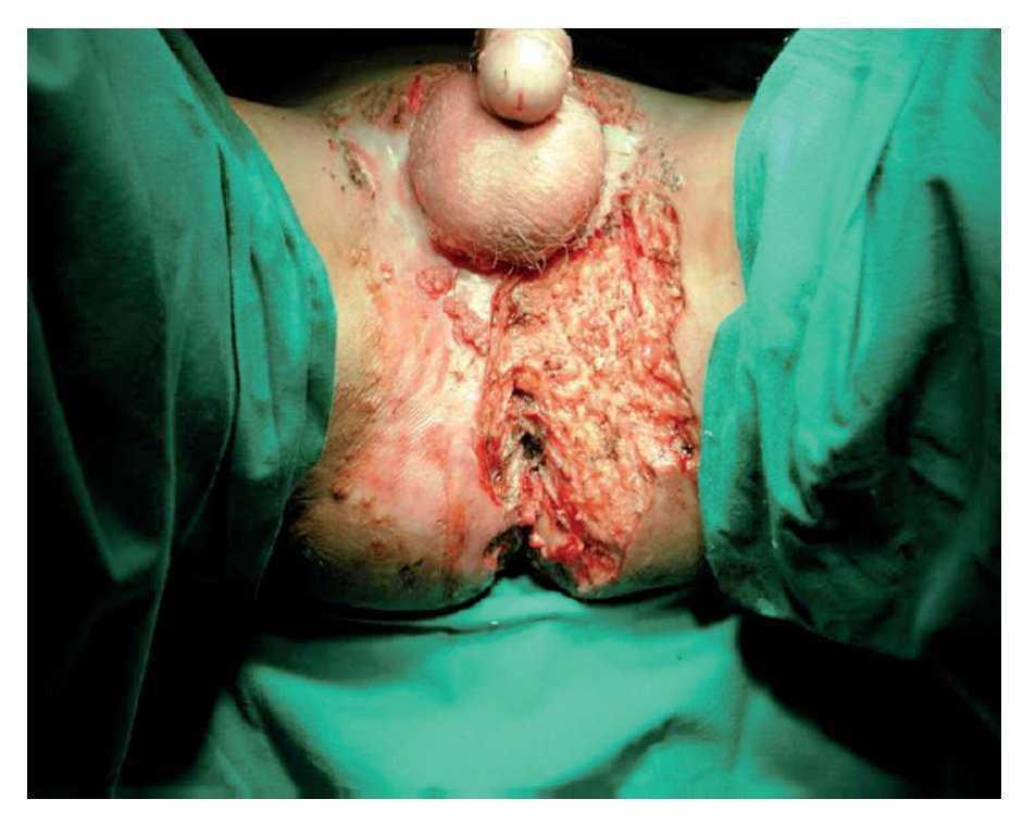 Tumor de Buschke-Lowenstein asociado a condilomatosis nasofaríngea | Revista de Gastroenterología de México