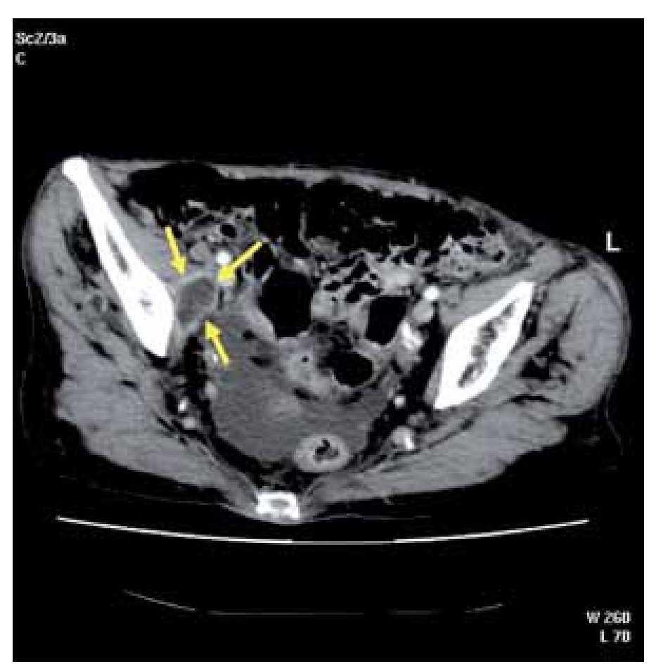 Psoas Abscess Due To Pasteurella Multocida Revista De Gastroenterologia De Mexico