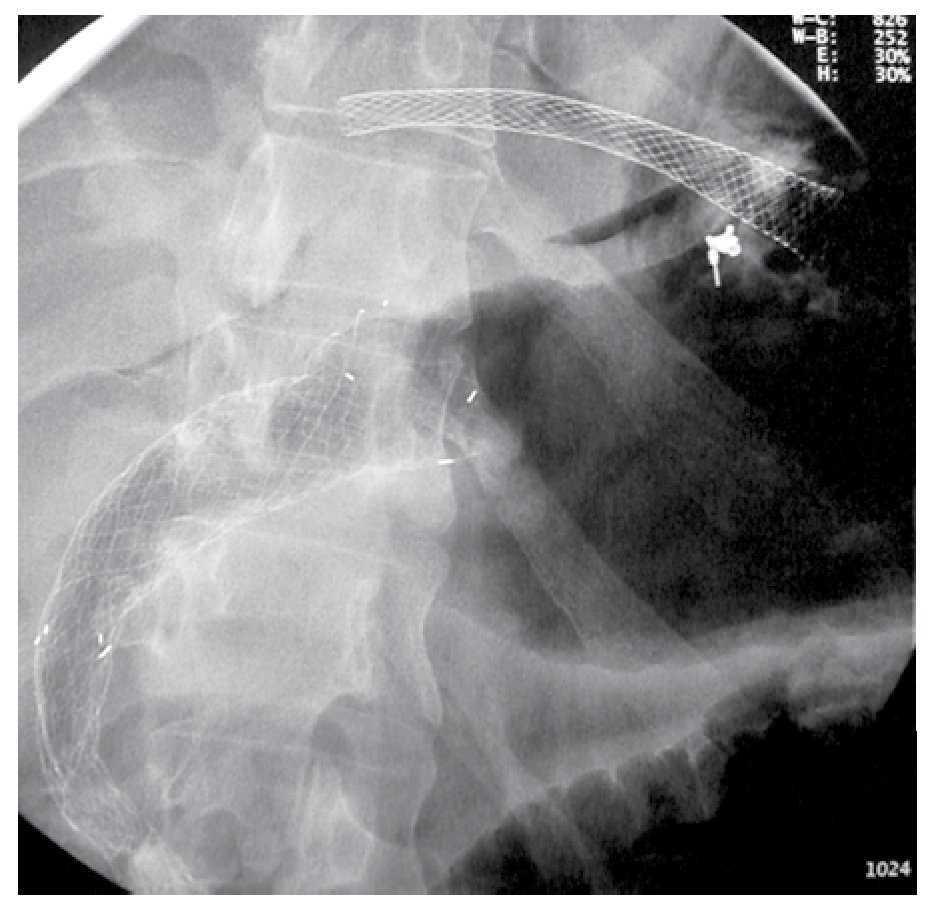 Gastric perforation related to a transgastric biliary drainage ...