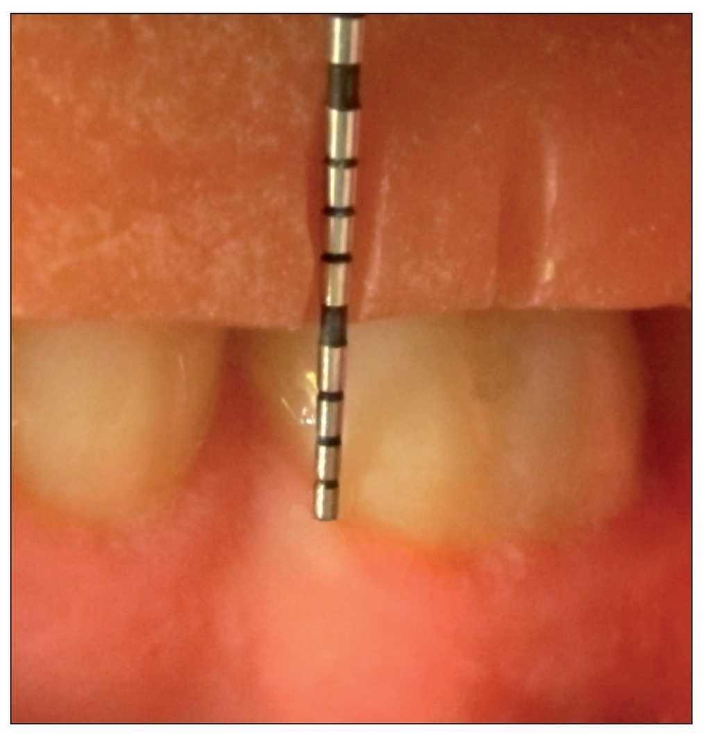 Evaluacion Clinica De Los Tejidos Periodontales Despues Del Aumento De Corona Clinica Revista Clinica De Periodoncia Implantologia Y Rehabilitacion Oral