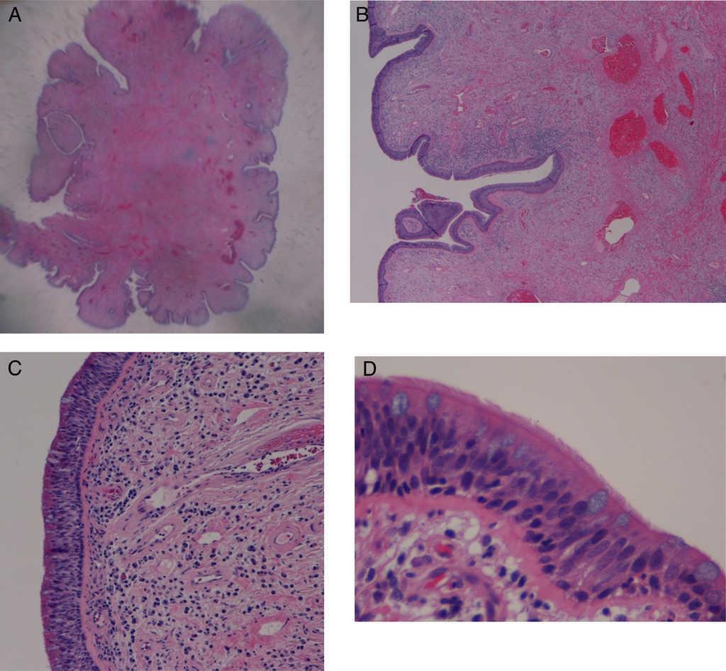 fibroepithelial polyp histology