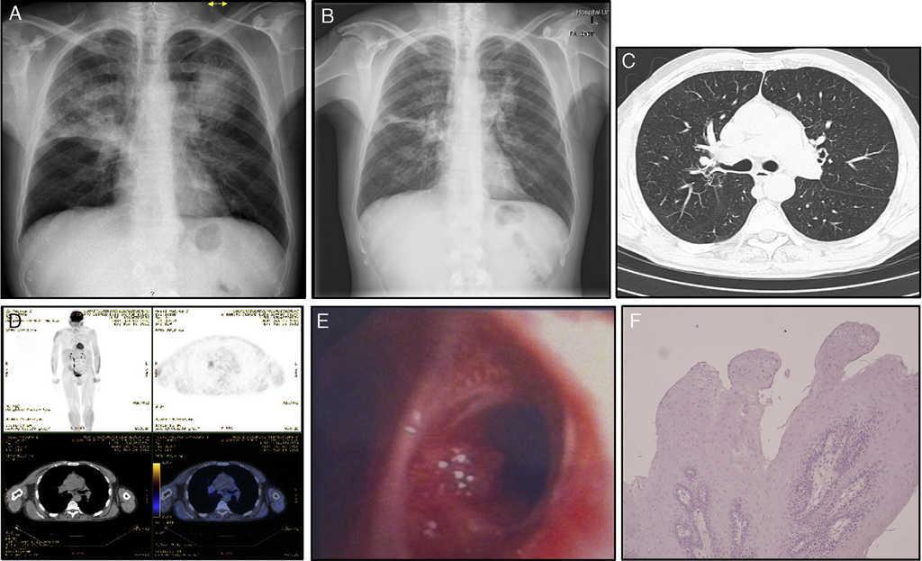 squamous papilloma lung