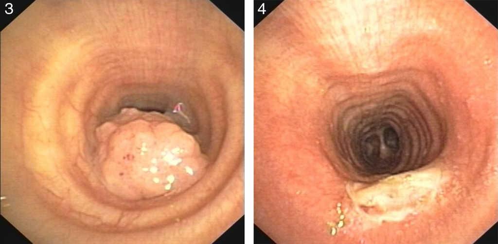 tracheal papillomatosis