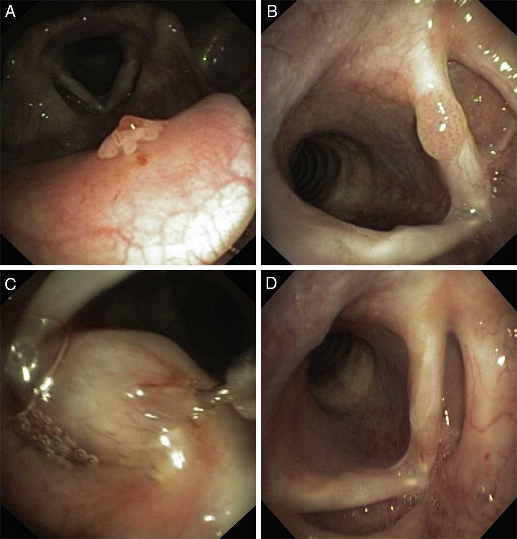 respiratory tract papillomas