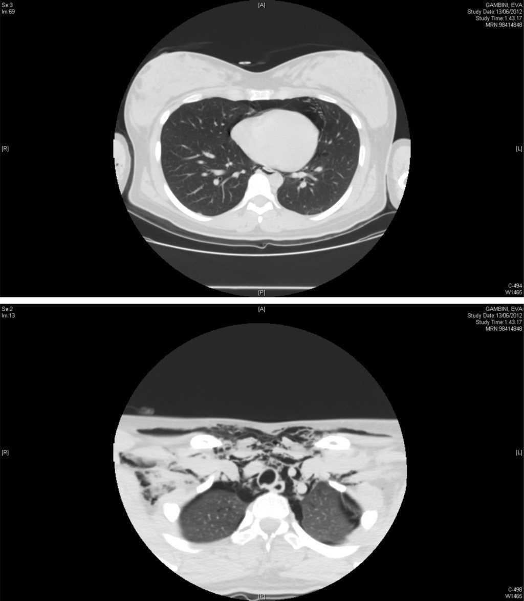 Spontaneous Pneumomediastinum In Pregnancy A Case Report Pulmonology