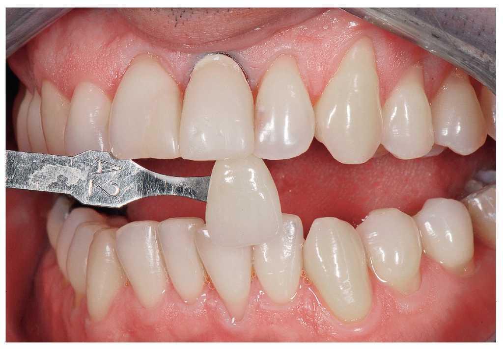 Siento Presión En Corona De Dental Estratificación cromáticamente análoga de una corona de dióxido de